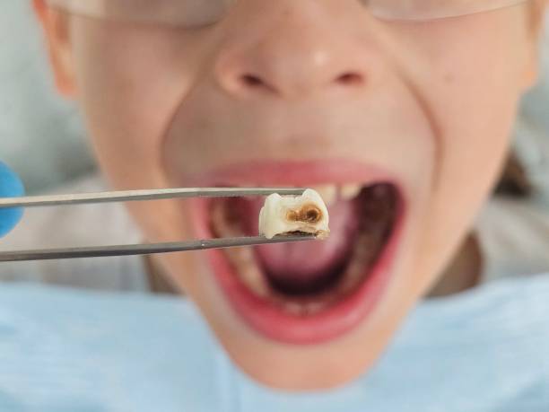 Best Chipped Tooth Repair Near Me  in Clairton, PA